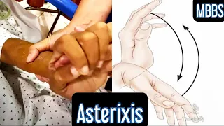 Asterixis- Flapping Hand Tremor!