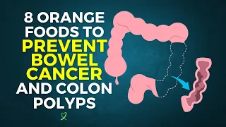 8 Orange Foods To Prevent Bowel Cancer and Colon Polyps