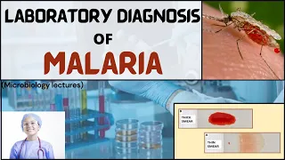 Laboratory Diagnosis of Malaria in Hindi | Malaria Lab Test | MICRO INSIGHTS