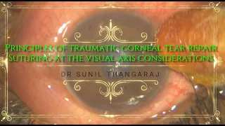 Principles involved while suturing a Corneal tear especially when encroaching onto the visual axis