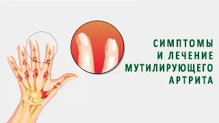 Симптомы и лечение мутилирующего артрита