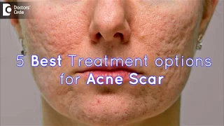 5 Best Treatment options for Acne Scar - Dr. Sankeerth Vijayakumar