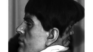 Urban Legends: The Curious Case of Edward Mordake, man with "two-faces", one in front, other in back