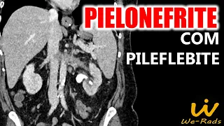 Pielonefrite com Pileflebite na Tomografia Computadorizada de Abdome com Contraste