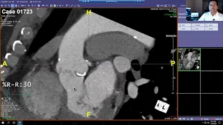 Cardiac CT for TAVR