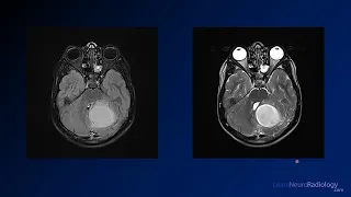 Neuroradiology board review 3 case 8