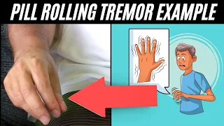 Pill rolling tremor - Parkinson's Disease example