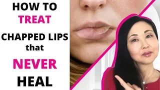 How to TREAT Chapped Lips that never heal  (Actinic Cheilitis-4 GRADES)