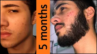 Minoxidil Beard Journey 5 MONTHS TRANSFORMATION