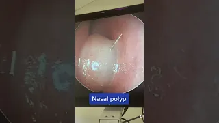 Nasal polyp