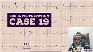 ECG INTERPRETATION CASE 19 |EKG| ELECTROCARDIOGRAM| EDUCATIONAL VIDEO