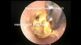 Ear wax removal ,Management of simple external auditory canal cerumen plugs in several patients