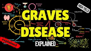 GRAVES DISEASE Pathogenesis Clinical symptoms Diagnostic criteria Treatment