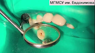 Лечение пульпита временного однокорневого зуба методом пульпотомии с использованием препарата МТА