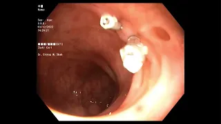 Endoscopic management of diverticular colonic bleeding