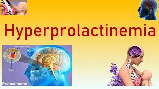 Hyperprolactinemia | Causes, Symptoms, Clinical Features, Diagnosis, Investigations and Management