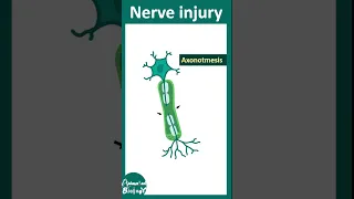 Types of nerve injury | neuropraxia | axonotmesis | neurotmesis | Wallerian degeneration | USMLE
