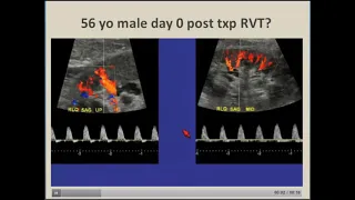 Renal transplant ultrasound