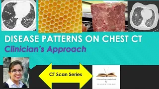 Pattern identification in CT Chest: A clinician's guide