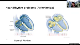 Amyloidosis and the Heart