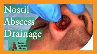 Nostril Abscess Drainage | Auburn Medical Group