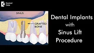 When is a sinus lift procedure done for dental implants? - Dr. Ranjani Rao