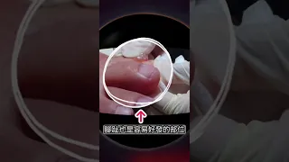 蝦米？！手指、腳指也會長果凍😱帶你看看果凍樣的神秘來源- #腱鞘囊腫 #吳仁欽 #皮膚科 #果凍樣 #肌腱瘤 #筋瘤