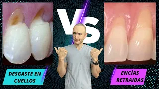 Desgaste en cuellos dentales VS Encías retraídas ¡NO LO CONFUNDAS!