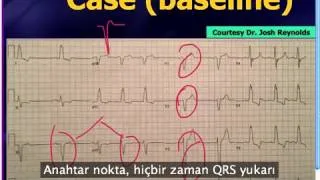 Mattu EKG Vakası: 17 Haziran 2013