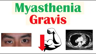 Myasthenia Gravis | Pathophysiology, Signs & Symptoms, Diagnosis, Treatment