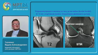 МРТ-диагностика травм и патологий коленного сустава», Вадим Александрович Ткаченко.