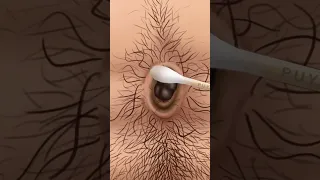 ASMR Dirt and stone removal in deep belly button| Remove Huge Navel Stone Animation | REVERSE VIDEO