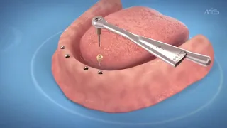 Dental Implants for a Toothless Jaw (3D medical animation)