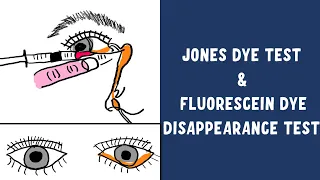 Understanding the Lacrimal Pump Mechanism | Jones Dye Test | FDDT Test