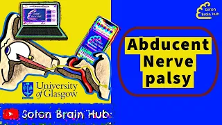 Abducent Nerve palsy