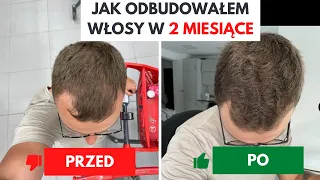 Wypadanie włosów | O tym NIKT Ci nie powiedział. 👀