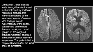 Creutzfeldt–Jakob Erkrankung