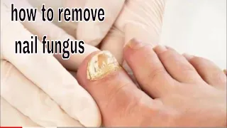 Homemade Solution  to End Nail Fungus