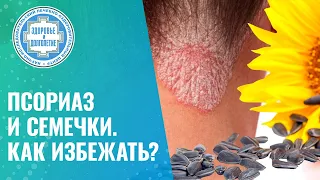 🌻  Псориаз и семечки. Как избежать?