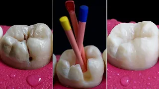 Superb Restoration Of Carious Tooth | Amazing Root Canal In 4K.