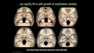 Pediatric Systemic Diseases Part2 Head and Neck Imaging ASHNR20 Session9