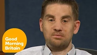 Face Transplant Recipient Talks About His New Life | Good Morning Britain