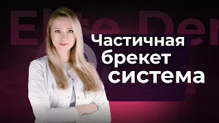 Частичная брекет-система