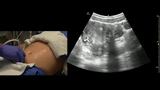 Transabdominal Pelvis Ultrasound Scanning Techniques