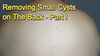 Removing Small Cysts on The Back -  Part I