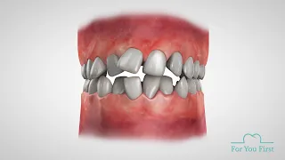 3D Animation showing teeth movements