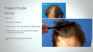 2000 FUT Graft Hair Transplant Comb-thru at 12 months post-op
