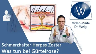 Herpes Zoster (Gürtelrose) durch Windpocken-Viren 😬 Schmerzen & Ausschlag - Entstehung & Therapie