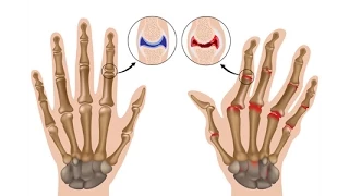 Rheumatoid Arthritis