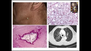 Renal Tumors Case 5